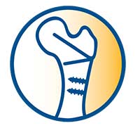 Icon bone secured with pins